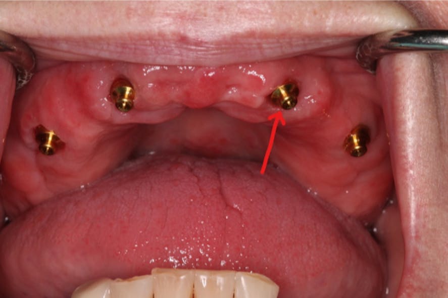 Figure 10: The attachment on No. 10 is divergent