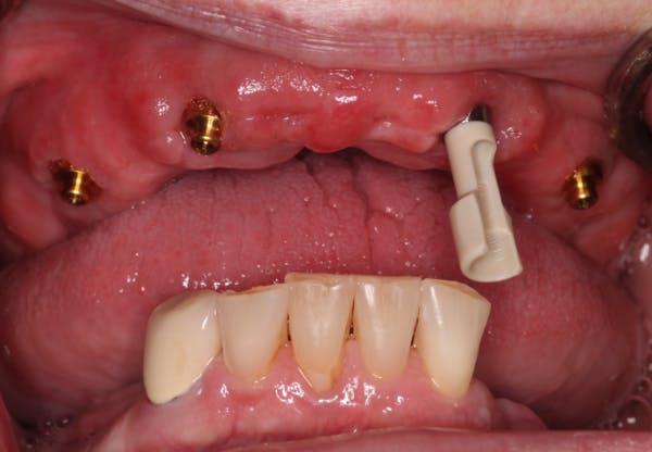 Figure 12: Placing the Access Abutment