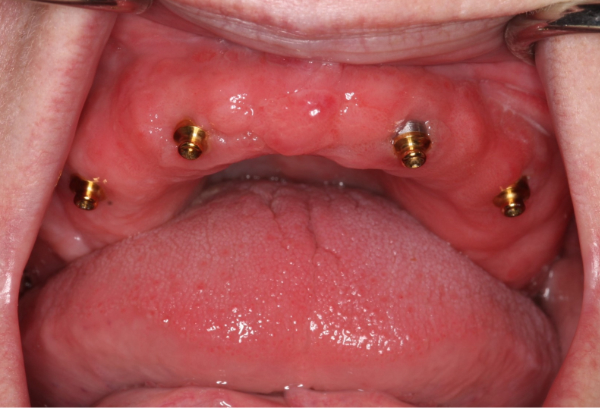 Dentures Removable Implants : Select Appropriate Attachment Types For Denture Retention.