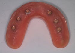 Figure 16: Denture one-and-a-half years after delivery Figure 16: Denture one-and-a-half years after delivery