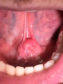 Figure 2: Initial presentation of lesion Figure 2: Initial presentation of lesion