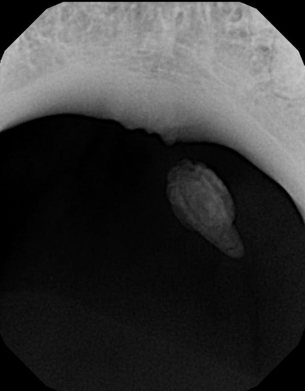 Figure 3: Radiograph showing sialolith of the submandibular gland blocking Wharton&apos;s duct