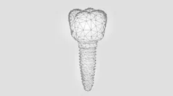 Content Dam Diq Online Articles 2019 02 Dental Implant Abstract 360x200