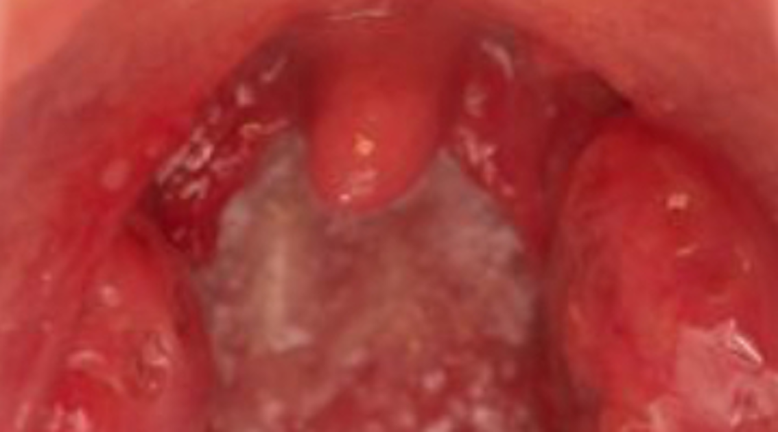 Tonsil stones: Symptoms, prevention, and treatment in the dental