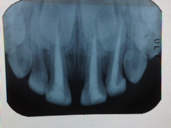Pulpectomy Radiograph