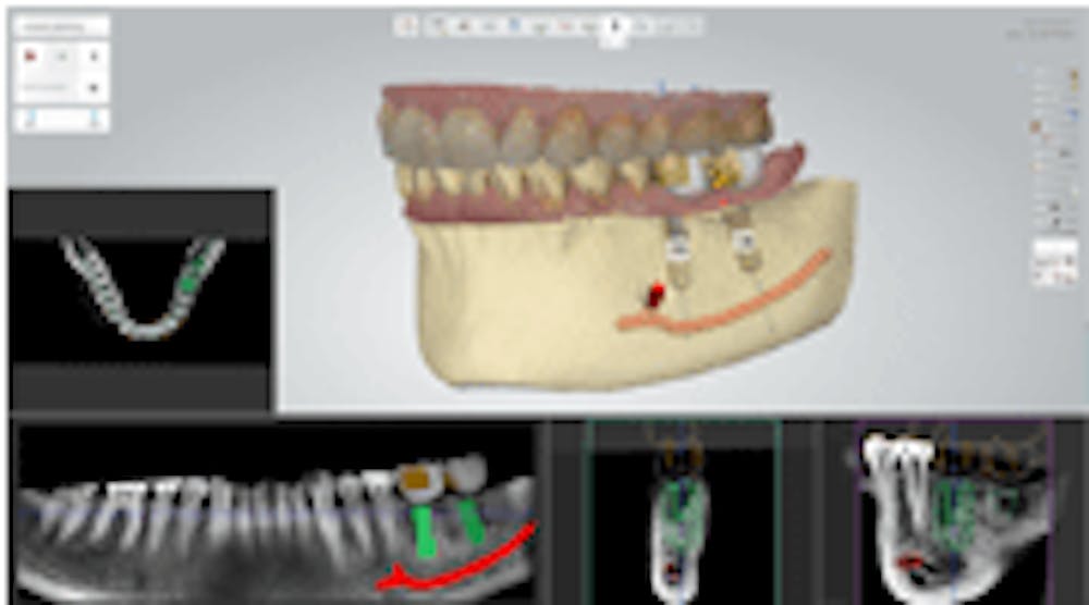 Content Dam Diq En Articles 2015 01 3shape Implant Studio Users Can Now Access Biohorizons Implants Leftcolumn Article Thumbnailimage File