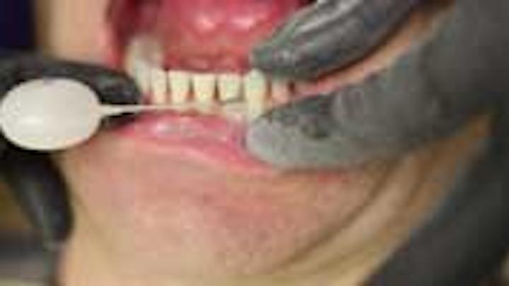 Content Dam Diq En Articles 2015 05 Pearls Enhanced Colleen Olson Rdh Demos Air Polishing With The Etchmaster By Groman Dental Leftcolumn Article Thumbnailimage File
