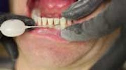 Content Dam Diq En Articles 2015 05 Pearls Enhanced Colleen Olson Rdh Demos Air Polishing With The Etchmaster By Groman Dental Leftcolumn Article Thumbnailimage File Content Dam Diq En Articles 2015 05 Pearls Enhanced Colleen Olson Rdh Demos Air Polishing With The Etchmaster By Groman Dental Leftcolumn Article Thumbnailimage File