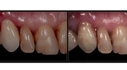 Content Dam Diq En Articles 2016 01 So Easy A Prosthodontist Can Do It A Simple And Cost Effective Method For Characterizing Acrylic Teeth And Denture Bases Leftcolumn Article Thumbnailimage File Content Dam Diq En Articles 2016 01 So Easy A Prosthodontist Can Do It A Simple And Cost Effective Method For Characterizing Acrylic Teeth And Denture Bases Leftcolumn Article Thumbnailimage File
