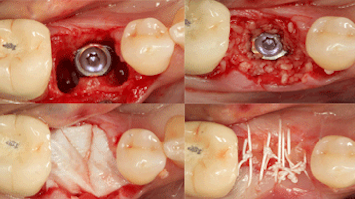 Content Dam Diq En Articles 2016 05 Using An Integrating Porcine Collagen Membrane To Decrease Treatment Times In Complex Implant Cases Leftcolumn Article Thumbnailimage File