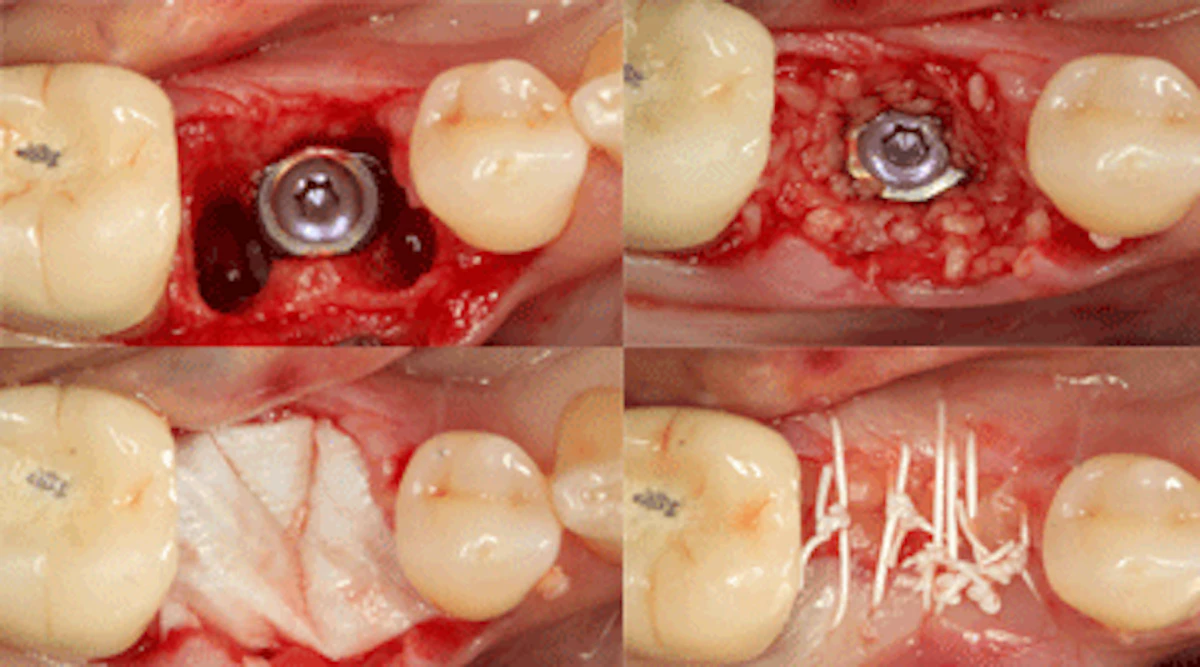 Using An Integrating Porcine Collagen Membrane To Decrease Treatment Times In Complex Implant Cases Dentistryiq