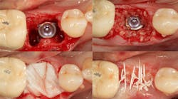 Content Dam Diq En Articles 2016 05 Using An Integrating Porcine Collagen Membrane To Decrease Treatment Times In Complex Implant Cases Leftcolumn Article Thumbnailimage File Content Dam Diq En Articles 2016 05 Using An Integrating Porcine Collagen Membrane To Decrease Treatment Times In Complex Implant Cases Leftcolumn Article Thumbnailimage File