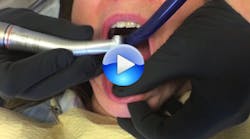 Content Dam Diq En Articles 2016 09 Pearls Enhanced Dr Austin Demos Shofu S Clear Attachment Removal Kit Video Leftcolumn Article Thumbnailimage File Content Dam Diq En Articles 2016 09 Pearls Enhanced Dr Austin Demos Shofu S Clear Attachment Removal Kit Video Leftcolumn Article Thumbnailimage File