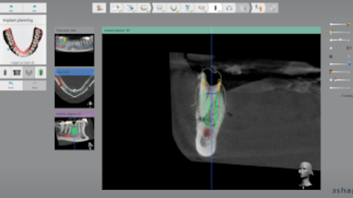 Content Dam Diq En Articles 2017 03 Case Report Streamlined Digital Implantology Using Implant Studio Software And The Form 2 3 D Printer Leftcolumn Article Thumbnailimage File