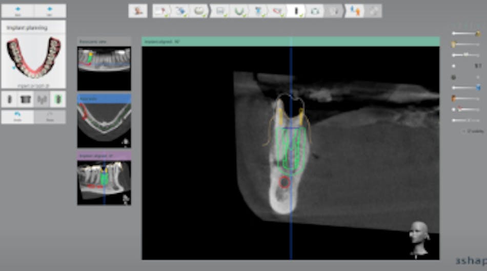 Content Dam Diq En Articles 2017 03 Case Report Streamlined Digital Implantology Using Implant Studio Software And The Form 2 3 D Printer Leftcolumn Article Thumbnailimage File