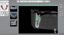 Content Dam Diq En Articles 2017 03 Case Report Streamlined Digital Implantology Using Implant Studio Software And The Form 2 3 D Printer Leftcolumn Article Thumbnailimage File Content Dam Diq En Articles 2017 03 Case Report Streamlined Digital Implantology Using Implant Studio Software And The Form 2 3 D Printer Leftcolumn Article Thumbnailimage File