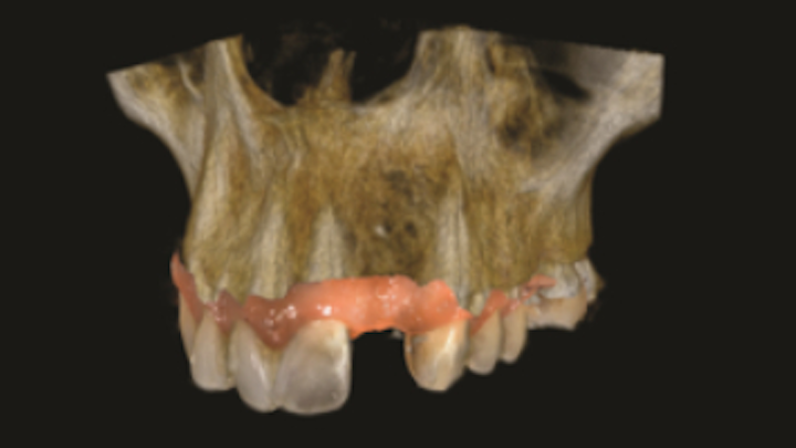 Content Dam Diq En Articles 2017 03 The Benefits Of Adding Prosthetic Driven Implant Planning To Your Practice Leftcolumn Article Thumbnailimage File