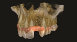 Content Dam Diq En Articles 2017 03 The Benefits Of Adding Prosthetic Driven Implant Planning To Your Practice Leftcolumn Article Thumbnailimage File Content Dam Diq En Articles 2017 03 The Benefits Of Adding Prosthetic Driven Implant Planning To Your Practice Leftcolumn Article Thumbnailimage File