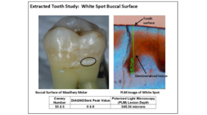 Content Dam Diq En Articles 2018 03 Caries Tools For Enhancing The Prevention And Management Of A Common Oral Disease Leftcolumn Article Thumbnailimage File