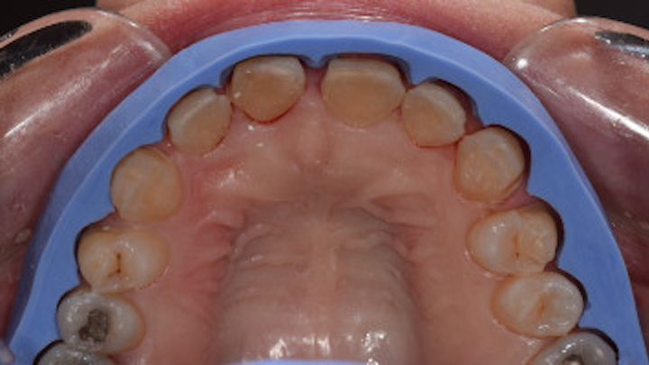 Content Dam Diq En Articles 2018 12 Predictable Esthetics Using Smile Design And A Balanced Occlusion In Centric Relation Leftcolumn Article Thumbnailimage File