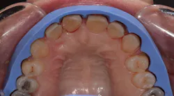 Content Dam Diq En Articles 2018 12 Predictable Esthetics Using Smile Design And A Balanced Occlusion In Centric Relation Leftcolumn Article Thumbnailimage File