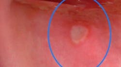 Content Dam Diq En Articles 2019 01 8 Steps For Documenting Oral Lesions Leftcolumn Article Thumbnailimage File Content Dam Diq En Articles 2019 01 8 Steps For Documenting Oral Lesions Leftcolumn Article Thumbnailimage File