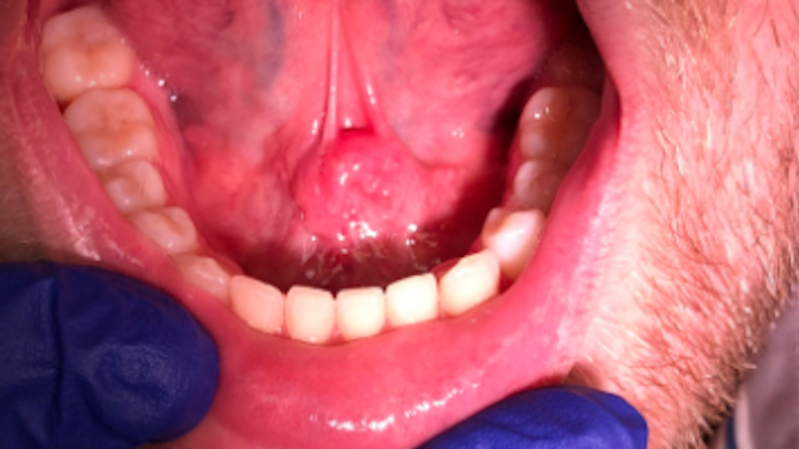 Content Dam Diq En Articles 2019 01 Bc Oral Pathology Case 39 The Non Bothersome Soft Tissue Lesion Leftcolumn Article Thumbnailimage File