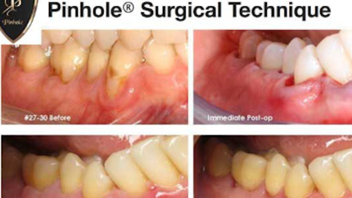 Content Dam Diq Online Articles 2019 03 Soft Tissue Grafting 1