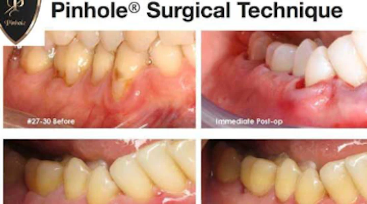 Dental Coding With Kyle Soft Tissue Grafting Dentistryiq