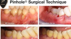 Content Dam Diq Online Articles 2019 03 Soft Tissue Grafting 1 Content Dam Diq Online Articles 2019 03 Soft Tissue Grafting 1