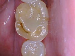 Knowles Ioc 19 Attrition 600x449 Knowles Ioc 19 Attrition 600x449