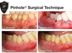 Soft Tissue Grafting Soft Tissue Grafting