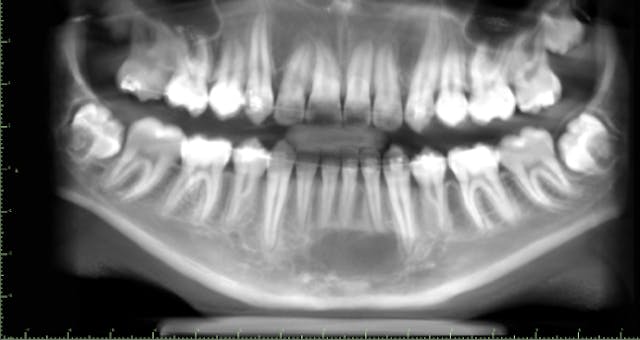 Diagnosis For Bc Oral Pathology Case 40 The Empty Lesion Dentistry Iq