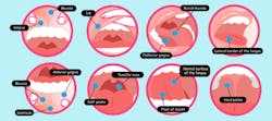 Brooks Oral Cancer Graphic Brooks Oral Cancer Graphic