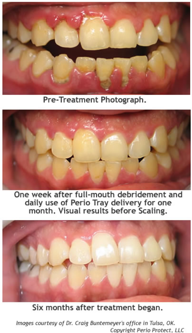 baking soda and peroxide for gums