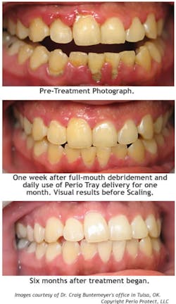 Perio Protect Treatment Perio Protect Treatment