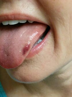 Tongue Bruise Due To Seizure Web