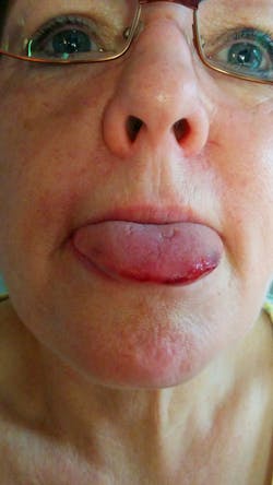 Tongue Damage Due To Seizure Web