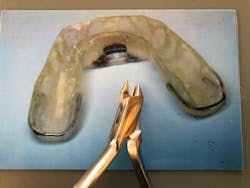 Figure 1: Appliance made by Thomas Schell, DMD Figure 1: Appliance made by Thomas Schell, DMD