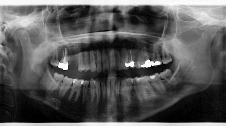 Figure 1: Radiograph taken six years prior to case presentation shows a radiopaque s-/oval-shaped lesion on the right side of the mandible just inferior to the apical roots of tooth No. 31.