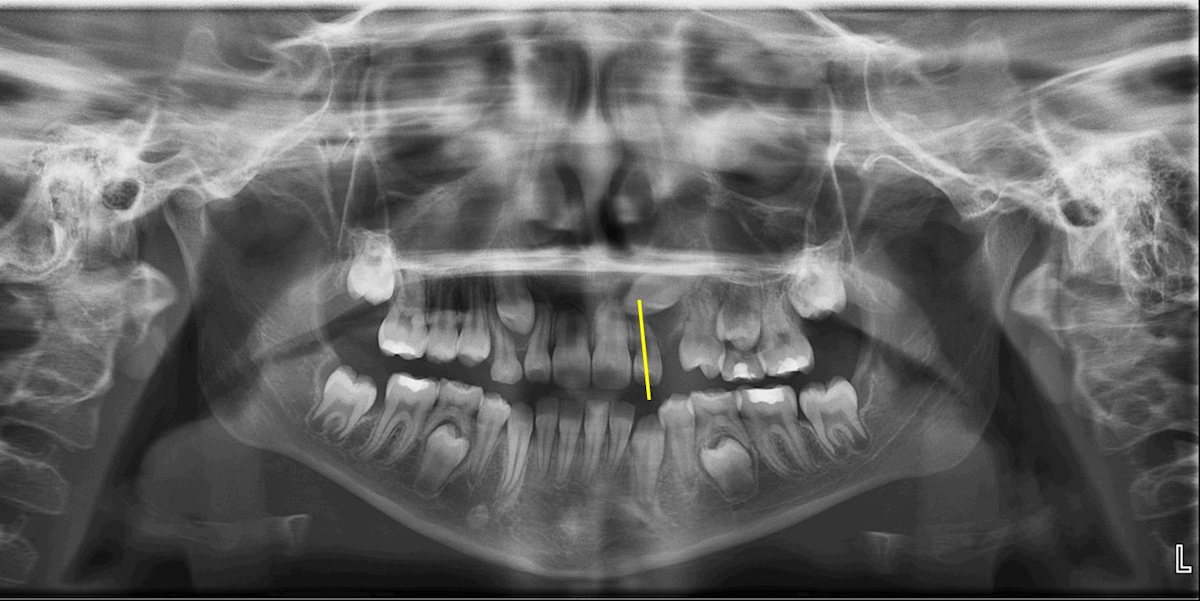 Recognizing The Potential For Impacted Maxillary Canines Dentistryiq
