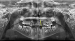 Figure 1: The panoramic radiograph (ProMax, Planmeca) shows how the crown of the maxillary left canine crosses the long axis of the lateral incisor, indicating a potential for canine impaction