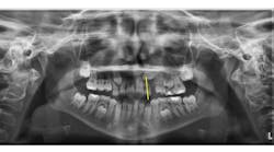 Figure 1: The panoramic radiograph (ProMax, Planmeca) shows how the crown of the maxillary left canine crosses the long axis of the lateral incisor, indicating a potential for canine impaction