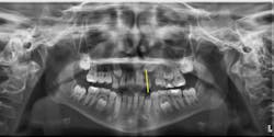 Figure 1: The panoramic radiograph (ProMax, Planmeca) shows how the crown of the maxillary left canine crosses the long axis of the lateral incisor, indicating a potential for canine impaction Figure 1: The panoramic radiograph (ProMax, Planmeca) shows how the crown of the maxillary left canine crosses the long axis of the lateral incisor, indicating a potential for canine impaction