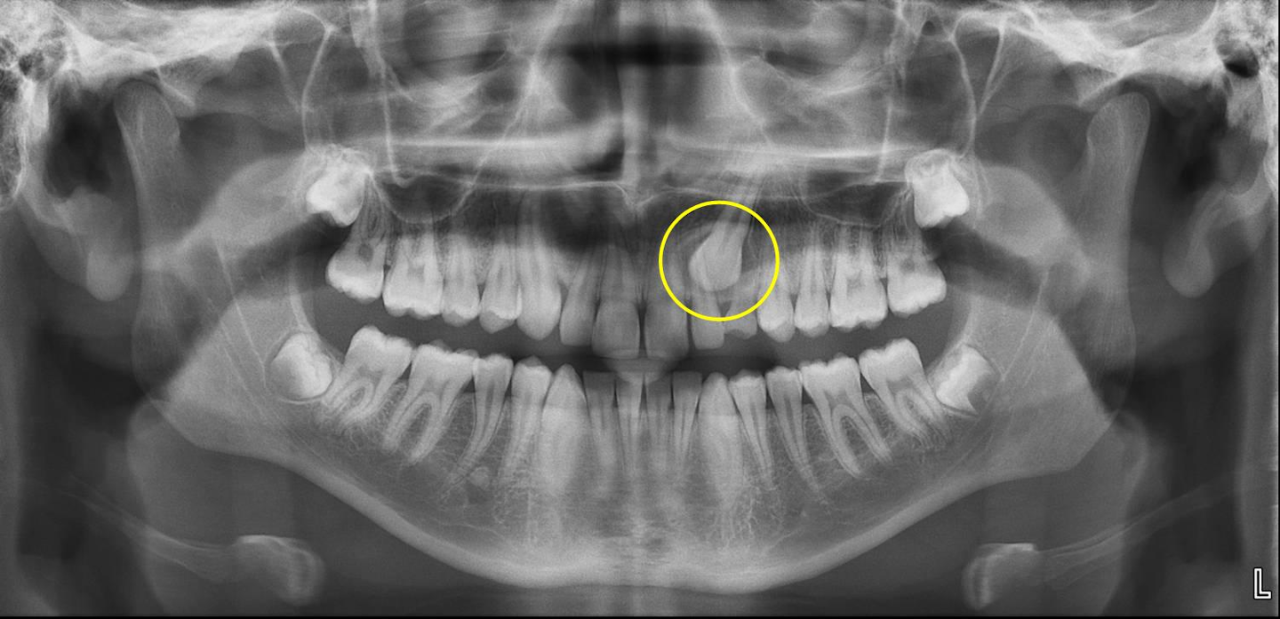 Recognizing The Potential For Impacted Maxillary Canines Dentistryiq