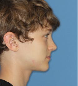 Figure 3: A straight profile of a six-year-old, indicating the potential for a class III growth pattern Figure 3: A straight profile of a six-year-old, indicating the potential for a class III growth pattern