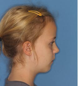 Figure 4: The normal class II, mandibular-deficient profile of a six-year-old