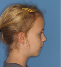 Figure 4: The normal class II, mandibular-deficient profile of a six-year-old Figure 4: The normal class II, mandibular-deficient profile of a six-year-old