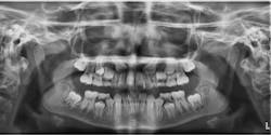 Figure 5: Severe root resorption on the maxillary right lateral incisor in a nine-year-old patient