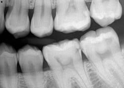 Figure 1: Class II caries Figure 1: Class II caries